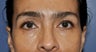 Lower lid blepharoplasty and Fat Transfer to lower lids and midface