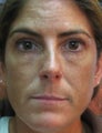 Restylane Injection to Tear Trough