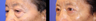 Lower Blepharoplasty (lower eyelids)