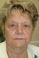 Bilateral upper and lower eyelid surgery