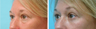 Lower Eyelids (blepharoplasty)