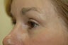 Lower eyelid surgery or lower blepharoplasty