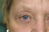 Ptosis repair with upper and lower blepharoplasties (Eyelid Surgery)