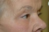 Ptosis repair, upper and lower eyelid surgery