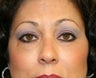 eyelid rejuvenation