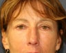 Upper and Lower eyelid blepharoplasty