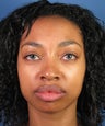 Eyelid Lift Blepharoplasty