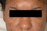 Dark Circles Under Eyes, Restylane Injections.