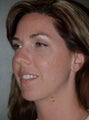 Chin Augmentation Surgery, Non-Surgical Under Eye Dermafillers