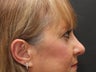Lower Blepharoplasty