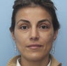 Eye Dermafillers,Cheek Dermafillers,Facial Dermafillers