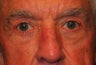 Extended lower lid blepharoplasty