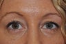 Bilateral Lower Eyelid Blepharoplasty
