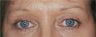 Endoscopic Browlift and Upper & Lower Blepharoplasty