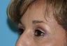 Lower Blepharoplasty