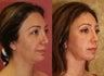 Eyelid surgery or blepharoplasty