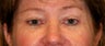 Eyelid surgery or blepharoplasty