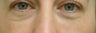 Under eye bag treatment