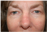 blepharoplasty