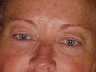 blepharoplasty