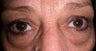 Bilateral upper lid blepharoplasty and Bilateral lower lid blepharoplasty