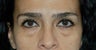 Lower lid blepharoplasty and Fat Transfer to lower lids and midface