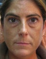 Restylane Injection to Tear Trough