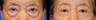 Lower Blepharoplasty (lower eyelids)