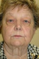 Bilateral upper and lower eyelid surgery