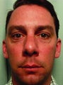 BOTOX combined with Juvederm Injections