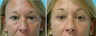 Lower Eyelids (blepharoplasty)