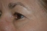 Lower eyelid surgery or lower blepharoplasty