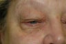 Ptosis repair with upper and lower blepharoplasties (Eyelid Surgery)