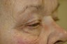 Ptosis repair, upper and lower eyelid surgery