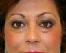 eyelid rejuvenation