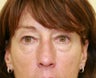 Upper and Lower eyelid blepharoplasty