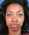 Eyelid Lift Blepharoplasty