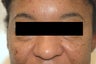 Dark Circles Under Eyes, Restylane Injections.