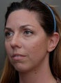 Chin Augmentation Surgery, Non-Surgical Under Eye Dermafillers