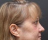 Lower Blepharoplasty