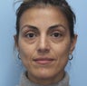 Eye Dermafillers,Cheek Dermafillers,Facial Dermafillers
