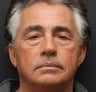Upper and Lower Belpharoplasty