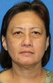 Upper Blepharoplasty,Lower Blepharoplasty, and Lower Eyelid Skin Pinch