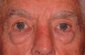 Extended lower lid blepharoplasty