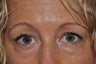 Bilateral Lower Eyelid Blepharoplasty