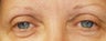 Endoscopic Browlift and Upper & Lower Blepharoplasty