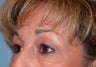 Lower Blepharoplasty