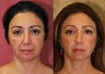 Eyelid surgery or blepharoplasty