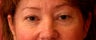 Eyelid surgery or blepharoplasty