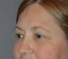 Upper Blepharoplasty (Eyelid Lift)